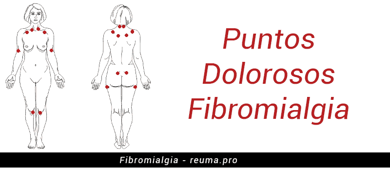 puntos dolorosos de la fibromialgia