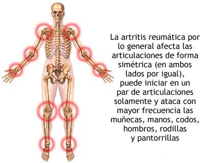 zonas afectadas por la artritis reumatoide